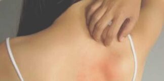 Hablemos de, alergias de la piel